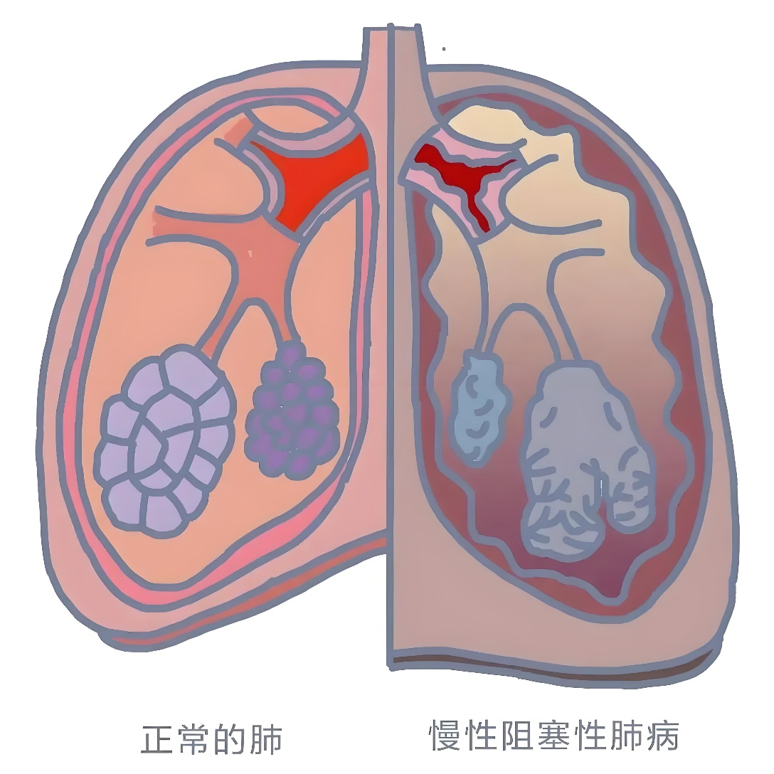 【健康科普】让生命自由呼吸，从了解慢阻肺开始(图1)