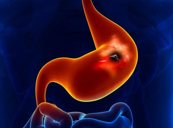 消化性溃疡与幽门螺杆菌:了解这种细菌的影响(图1)