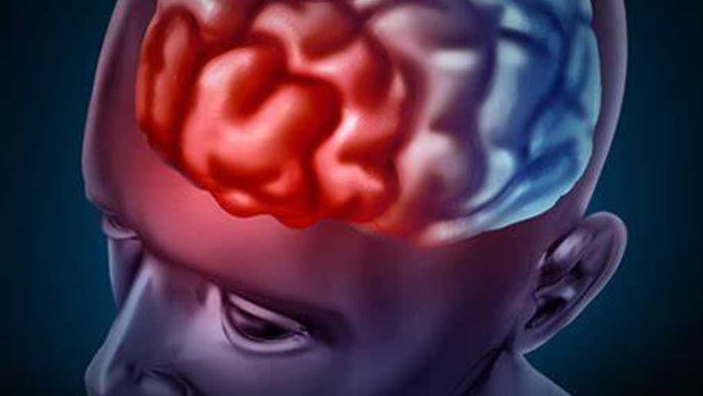 脑出血的早期症状有哪些？如何识别？(图1)