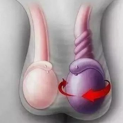 睾丸扭转的识别与处理(图1)