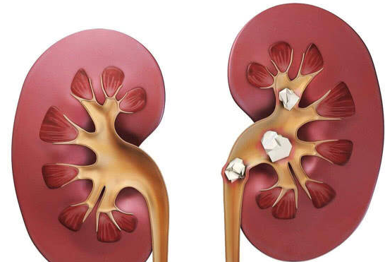 肾结石悄然而至 “石”你痛不欲生(图1)