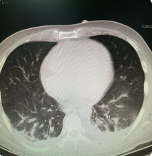 胸腔积液一般是由什么疾病造成的，该如何诊治(图1)