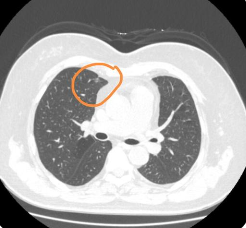 胸腔积液一般是由什么疾病造成的，该如何诊治(图2)