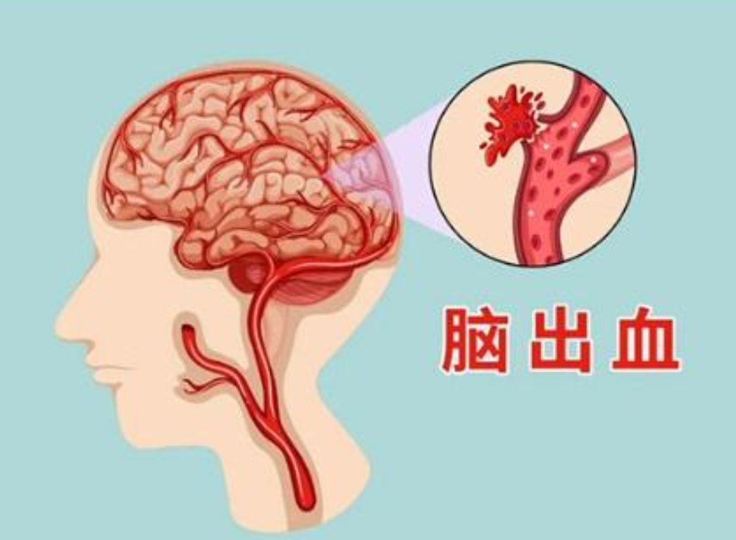 什么是脑出血的早期症状和预警信号?(图1) 什么是脑出血的早期症状和预警信号?(图1)