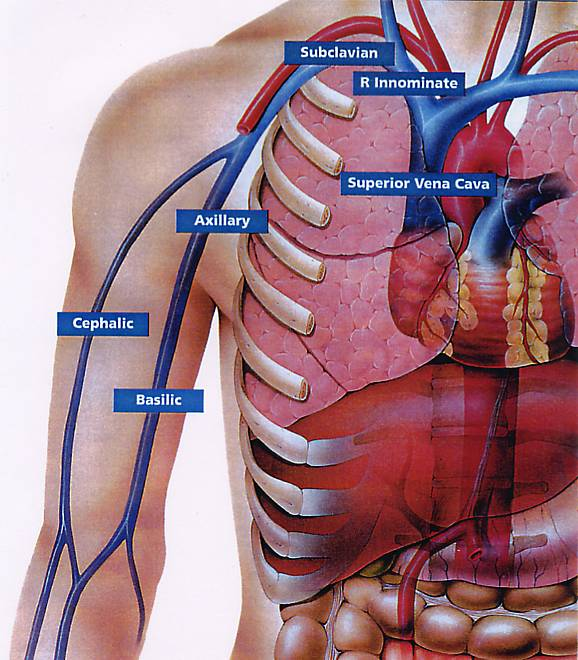 从手臂到生命的桥梁，PICC置管术揭秘(图1)