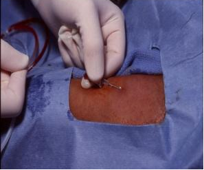 从手臂到生命的桥梁，PICC置管术揭秘(图2)