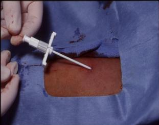 从手臂到生命的桥梁，PICC置管术揭秘(图3)