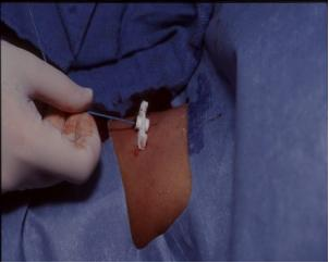 从手臂到生命的桥梁，PICC置管术揭秘(图4)