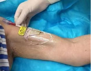 从手臂到生命的桥梁，PICC置管术揭秘(图5)