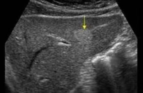 体检超声报告中此“瘤”非彼瘤(图1)