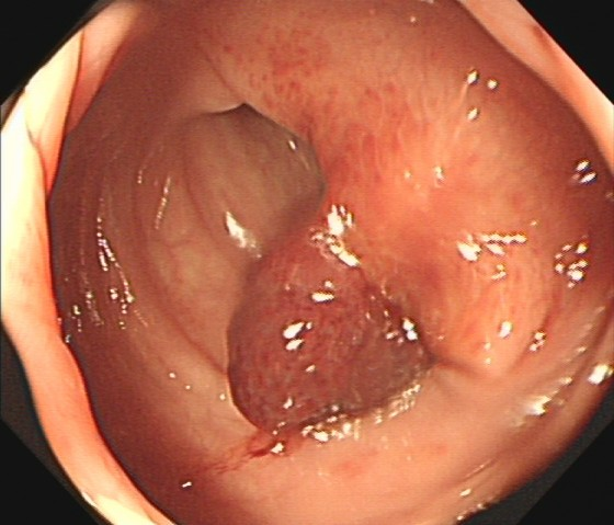 肠镜一照，息肉现形！形态各异的大肠息肉，离癌有多远？(图2)