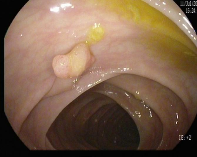 肠镜一照，息肉现形！形态各异的大肠息肉，离癌有多远？(图5)