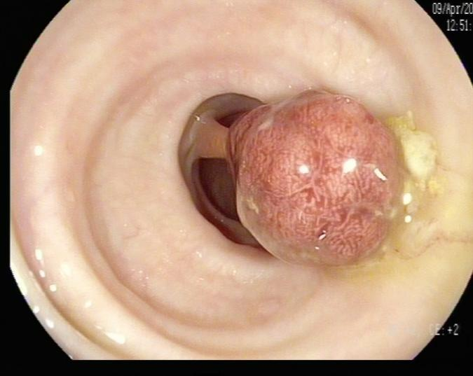 肠镜一照，息肉现形！形态各异的大肠息肉，离癌有多远？(图6)