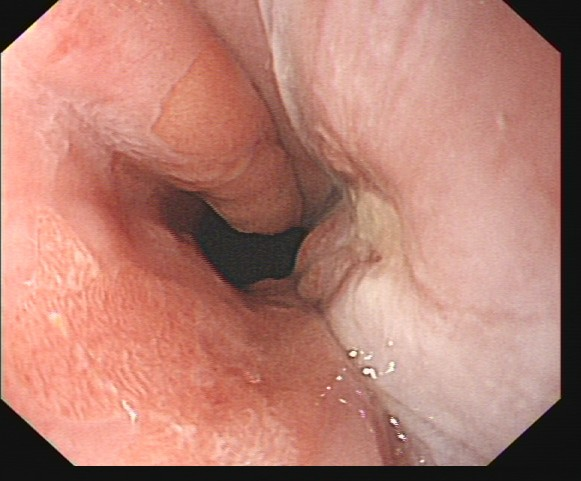 除了肚子疼，这些信号别忽视！消化性溃疡的“隐秘”症状(图1)