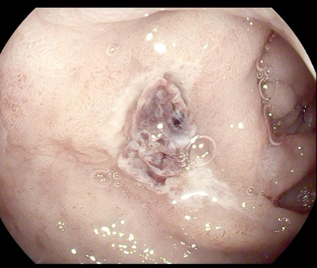 除了肚子疼，这些信号别忽视！消化性溃疡的“隐秘”症状(图8)