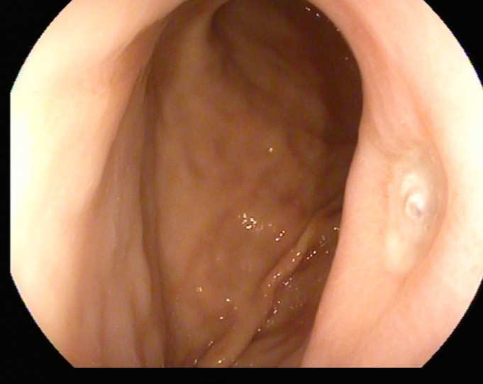 除了肚子疼，这些信号别忽视！消化性溃疡的“隐秘”症状(图2)