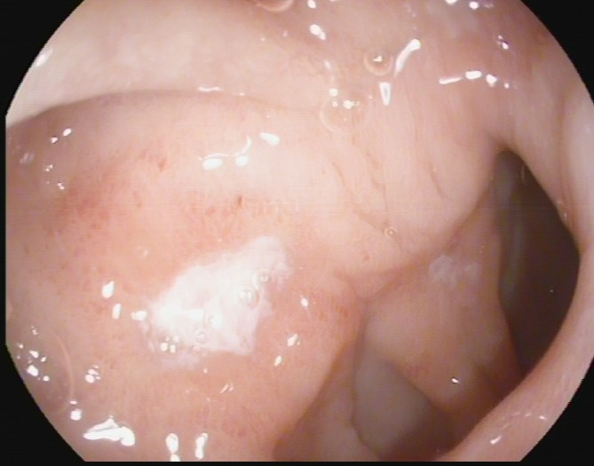 除了肚子疼，这些信号别忽视！消化性溃疡的“隐秘”症状(图3)