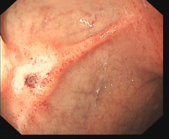 除了肚子疼，这些信号别忽视！消化性溃疡的“隐秘”症状(图4)