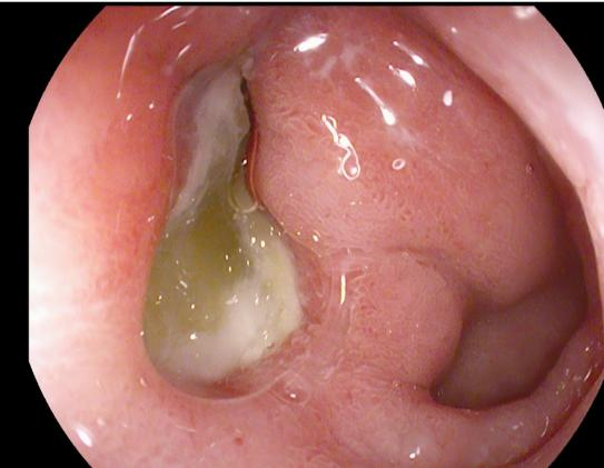 除了肚子疼，这些信号别忽视！消化性溃疡的“隐秘”症状(图6)