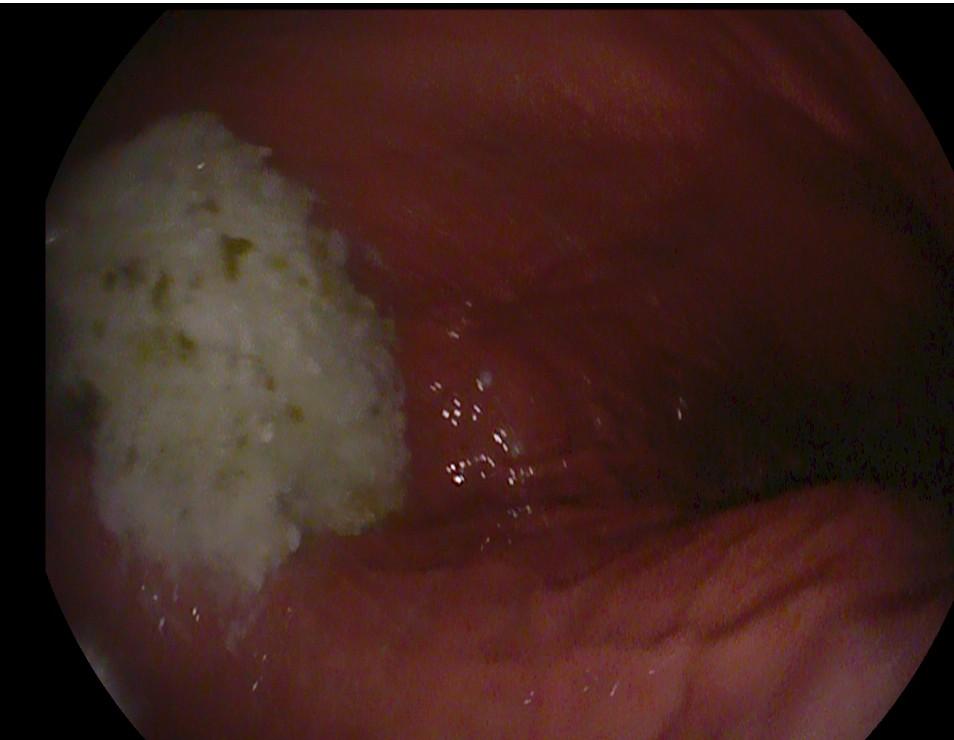 除了肚子疼，这些信号别忽视！消化性溃疡的“隐秘”症状(图7)