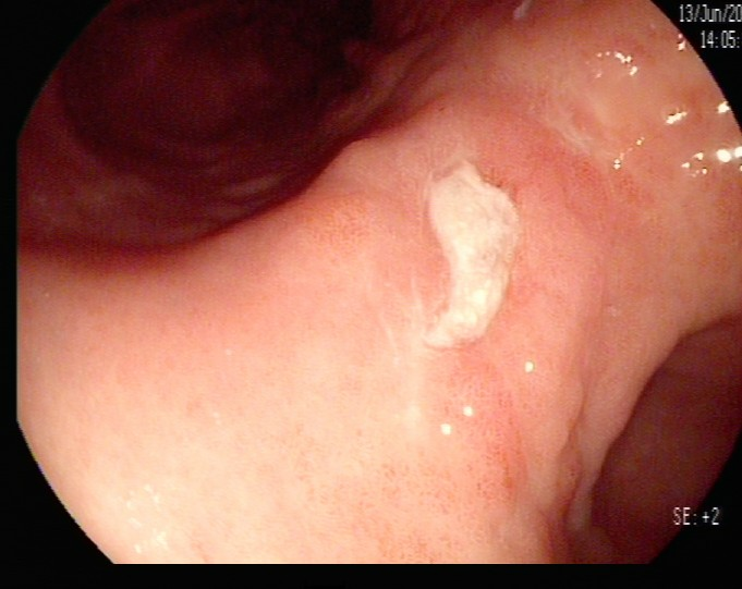 除了肚子疼，这些信号别忽视！消化性溃疡的“隐秘”症状(图8)