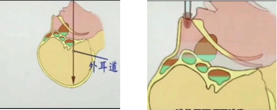 解锁大鼻孔如何配合鼻负压置换技术?(图3)