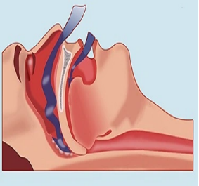 解锁大鼻孔如何配合鼻负压置换技术?(图2)