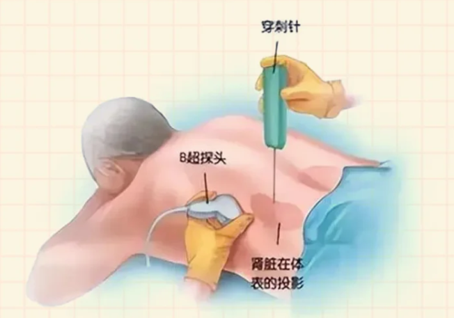 肾穿刺活检术：微创精准，肾脏健康“侦察兵”—— 一文读懂“肾穿”那些事(图1)
