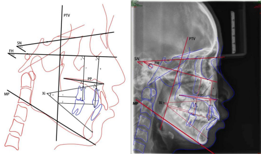 儿童早期矫治的选择和误区(图2)