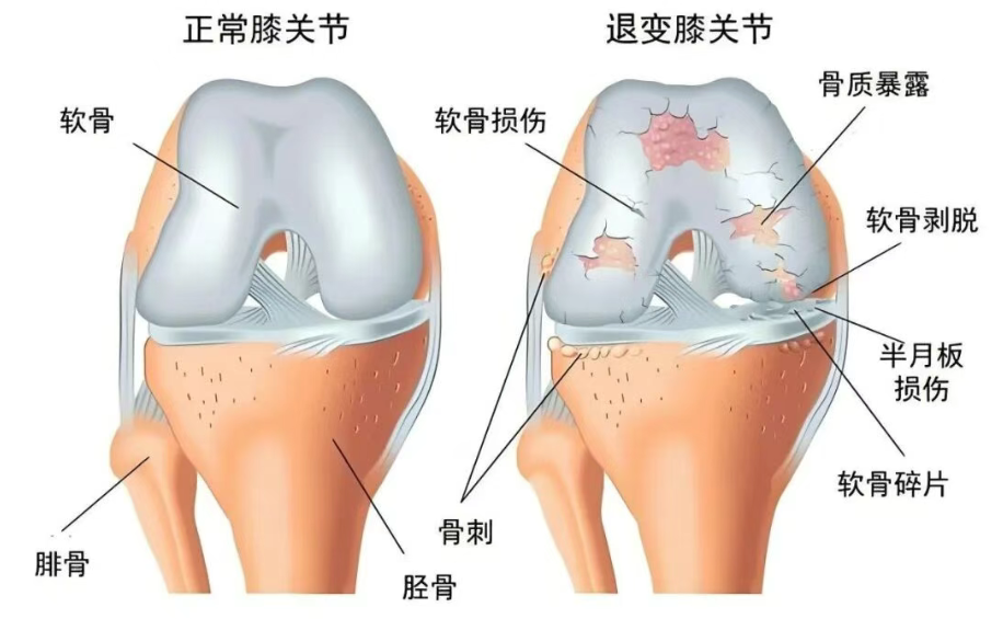 且行且珍“膝！膝盖痛千万别硬抗!(图1)
